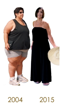 Sandi - Before and After Weight Loss Surgery